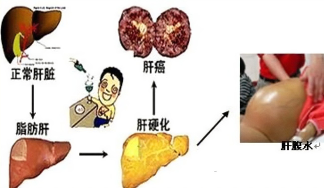 查出肝硬化還有救嗎？